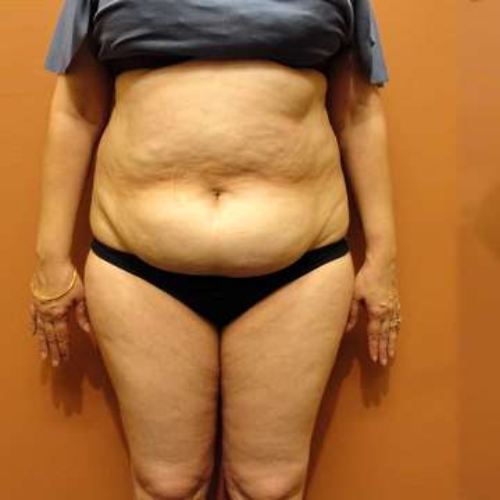 Antes